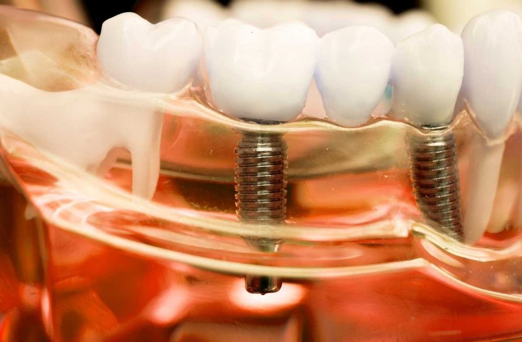 Dental Care Implants