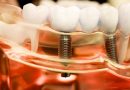 Dental Care Implants