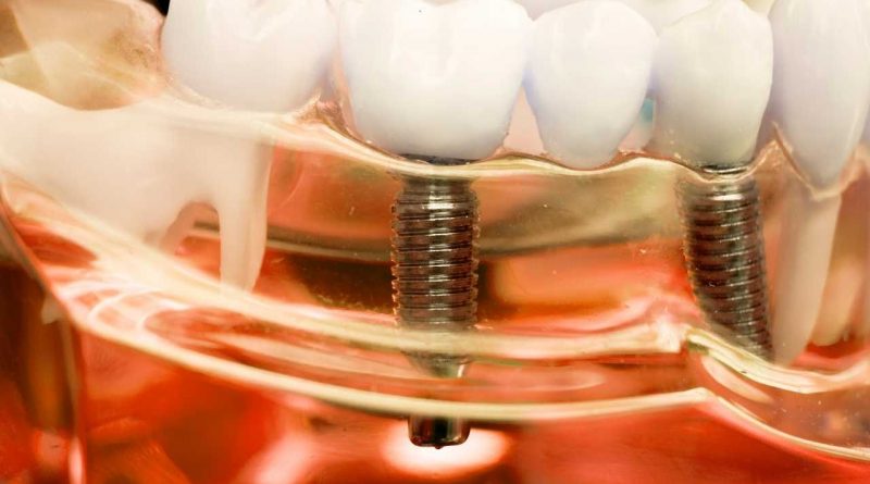 Dental Care Implants