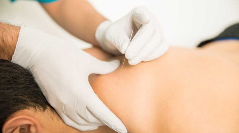 Dry Needling Physical Therapy